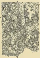 An illustration from Cancer of the uterus : its pathology, symptomatology, diagnosis, and treatment : also the pathology of diseases of the endometrium / by Thomas Stephen Cullen ; with eleven lithographic plates and over three hundred coloured and black illustrations in the text by May Brödel and Hermann Becker. (1900)