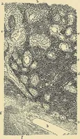An illustration from Cancer of the uterus : its pathology, symptomatology, diagnosis, and treatment : also the pathology of diseases of the endometrium / by Thomas Stephen Cullen ; with eleven lithographic plates and over three hundred coloured and black illustrations in the text by May Brödel and Hermann Becker. (1900)