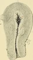 An illustration from Cancer of the uterus : its pathology, symptomatology, diagnosis, and treatment : also the pathology of diseases of the endometrium / by Thomas Stephen Cullen ; with eleven lithographic plates and over three hundred coloured and black illustrations in the text by May Brödel and Hermann Becker. (1900)