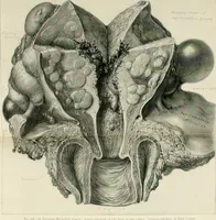 An illustration from Cancer of the uterus : its pathology, symptomatology, diagnosis, and treatment : also the pathology of diseases of the endometrium / by Thomas Stephen Cullen ; with eleven lithographic plates and over three hundred coloured and black illustrations in the text by May Brödel and Hermann Becker. (1900)