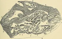 An illustration from Cancer of the uterus : its pathology, symptomatology, diagnosis, and treatment : also the pathology of diseases of the endometrium / by Thomas Stephen Cullen ; with eleven lithographic plates and over three hundred coloured and black illustrations in the text by May Brödel and Hermann Becker. (1900)
