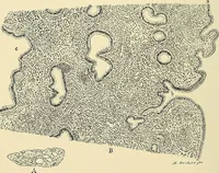 An illustration from Cancer of the uterus : its pathology, symptomatology, diagnosis, and treatment : also the pathology of diseases of the endometrium / by Thomas Stephen Cullen ; with eleven lithographic plates and over three hundred coloured and black illustrations in the text by May Brödel and Hermann Becker. (1900)