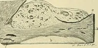 An illustration from Cancer of the uterus : its pathology, symptomatology, diagnosis, and treatment : also the pathology of diseases of the endometrium / by Thomas Stephen Cullen ; with eleven lithographic plates and over three hundred coloured and black illustrations in the text by May Brödel and Hermann Becker. (1900)