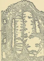 An illustration from Cancer of the uterus : its pathology, symptomatology, diagnosis, and treatment : also the pathology of diseases of the endometrium / by Thomas Stephen Cullen ; with eleven lithographic plates and over three hundred coloured and black illustrations in the text by May Brödel and Hermann Becker. (1900)