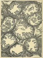 An illustration from Cancer of the uterus : its pathology, symptomatology, diagnosis, and treatment : also the pathology of diseases of the endometrium / by Thomas Stephen Cullen ; with eleven lithographic plates and over three hundred coloured and black illustrations in the text by May Brödel and Hermann Becker. (1900)
