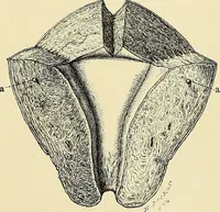 An illustration from Cancer of the uterus : its pathology, symptomatology, diagnosis, and treatment : also the pathology of diseases of the endometrium / by Thomas Stephen Cullen ; with eleven lithographic plates and over three hundred coloured and black illustrations in the text by May Brödel and Hermann Becker. (1900)