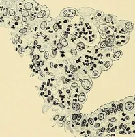 An illustration from Cancer of the uterus : its pathology, symptomatology, diagnosis, and treatment : also the pathology of diseases of the endometrium / by Thomas Stephen Cullen ; with eleven lithographic plates and over three hundred coloured and black illustrations in the text by May Brödel and Hermann Becker. (1900)