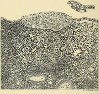 An illustration from Cancer of the uterus : its pathology, symptomatology, diagnosis, and treatment : also the pathology of diseases of the endometrium / by Thomas Stephen Cullen ; with eleven lithographic plates and over three hundred coloured and black illustrations in the text by May Brödel and Hermann Becker. (1900)