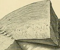 An illustration from Cancer of the uterus : its pathology, symptomatology, diagnosis, and treatment : also the pathology of diseases of the endometrium / by Thomas Stephen Cullen ; with eleven lithographic plates and over three hundred coloured and black illustrations in the text by May Brödel and Hermann Becker. (1900)