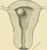 An illustration from Cancer of the uterus : its pathology, symptomatology, diagnosis, and treatment : also the pathology of diseases of the endometrium / by Thomas Stephen Cullen ; with eleven lithographic plates and over three hundred coloured and black illustrations in the text by May Brödel and Hermann Becker. (1900)