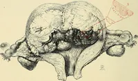 An illustration from Cancer of the uterus : its pathology, symptomatology, diagnosis, and treatment : also the pathology of diseases of the endometrium / by Thomas Stephen Cullen ; with eleven lithographic plates and over three hundred coloured and black illustrations in the text by May Brödel and Hermann Becker. (1900)