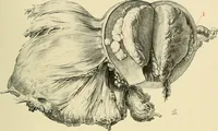 An illustration from Cancer of the uterus : its pathology, symptomatology, diagnosis, and treatment : also the pathology of diseases of the endometrium / by Thomas Stephen Cullen ; with eleven lithographic plates and over three hundred coloured and black illustrations in the text by May Brödel and Hermann Becker. (1900)