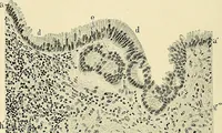An illustration from Cancer of the uterus : its pathology, symptomatology, diagnosis, and treatment : also the pathology of diseases of the endometrium / by Thomas Stephen Cullen ; with eleven lithographic plates and over three hundred coloured and black illustrations in the text by May Brödel and Hermann Becker. (1900)