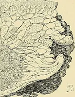 An illustration from Cancer of the uterus : its pathology, symptomatology, diagnosis, and treatment : also the pathology of diseases of the endometrium / by Thomas Stephen Cullen ; with eleven lithographic plates and over three hundred coloured and black illustrations in the text by May Brödel and Hermann Becker. (1900)