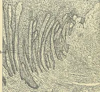 An illustration from Cancer of the uterus : its pathology, symptomatology, diagnosis, and treatment : also the pathology of diseases of the endometrium / by Thomas Stephen Cullen ; with eleven lithographic plates and over three hundred coloured and black illustrations in the text by May Brödel and Hermann Becker. (1900)
