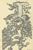 An illustration from Cancer of the uterus : its pathology, symptomatology, diagnosis, and treatment : also the pathology of diseases of the endometrium / by Thomas Stephen Cullen ; with eleven lithographic plates and over three hundred coloured and black illustrations in the text by May Brödel and Hermann Becker. (1900)