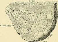 An illustration from Cancer of the uterus : its pathology, symptomatology, diagnosis, and treatment : also the pathology of diseases of the endometrium / by Thomas Stephen Cullen ; with eleven lithographic plates and over three hundred coloured and black illustrations in the text by May Brödel and Hermann Becker. (1900)