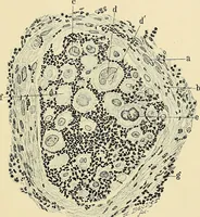 An illustration from Cancer of the uterus : its pathology, symptomatology, diagnosis, and treatment : also the pathology of diseases of the endometrium / by Thomas Stephen Cullen ; with eleven lithographic plates and over three hundred coloured and black illustrations in the text by May Brödel and Hermann Becker. (1900)