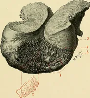An illustration from Cancer of the uterus : its pathology, symptomatology, diagnosis, and treatment : also the pathology of diseases of the endometrium / by Thomas Stephen Cullen ; with eleven lithographic plates and over three hundred coloured and black illustrations in the text by May Brödel and Hermann Becker. (1900)