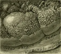 An illustration from Cancer of the uterus : its pathology, symptomatology, diagnosis, and treatment : also the pathology of diseases of the endometrium / by Thomas Stephen Cullen ; with eleven lithographic plates and over three hundred coloured and black illustrations in the text by May Brödel and Hermann Becker. (1900)