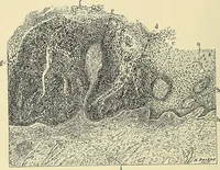 An illustration from Cancer of the uterus : its pathology, symptomatology, diagnosis, and treatment : also the pathology of diseases of the endometrium / by Thomas Stephen Cullen ; with eleven lithographic plates and over three hundred coloured and black illustrations in the text by May Brödel and Hermann Becker. (1900)