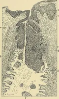 An illustration from Cancer of the uterus : its pathology, symptomatology, diagnosis, and treatment : also the pathology of diseases of the endometrium / by Thomas Stephen Cullen ; with eleven lithographic plates and over three hundred coloured and black illustrations in the text by May Brödel and Hermann Becker. (1900)