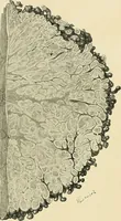 An illustration from Cancer of the uterus : its pathology, symptomatology, diagnosis, and treatment : also the pathology of diseases of the endometrium / by Thomas Stephen Cullen ; with eleven lithographic plates and over three hundred coloured and black illustrations in the text by May Brödel and Hermann Becker. (1900)