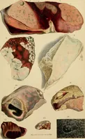 An illustration from Principles and illustrations of morbid anatomy : adapted to the elements of M. Andral, and to the cyclopaedia of practical medicine, being a complete series of coloured lithographic drawings, from originals by the author : with descriptions and summary allusions to cases, symptoms, treatment, &c. : designed to constitute an appendix to works on the practice of physic, and to facilitate the study of morbid anatomy in connexion with symptoms / by J. Hope. (1834)