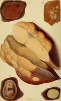 An illustration from Principles and illustrations of morbid anatomy : adapted to the elements of M. Andral, and to the cyclopaedia of practical medicine, being a complete series of coloured lithographic drawings, from originals by the author : with descriptions and summary allusions to cases, symptoms, treatment, &c. : designed to constitute an appendix to works on the practice of physic, and to facilitate the study of morbid anatomy in connexion with symptoms / by J. Hope. (1834)