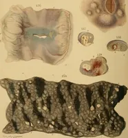 An illustration from Principles and illustrations of morbid anatomy : adapted to the elements of M. Andral, and to the cyclopaedia of practical medicine, being a complete series of coloured lithographic drawings, from originals by the author : with descriptions and summary allusions to cases, symptoms, treatment, &c. : designed to constitute an appendix to works on the practice of physic, and to facilitate the study of morbid anatomy in connexion with symptoms / by J. Hope. (1834)