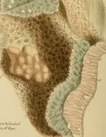 An illustration from Principles and illustrations of morbid anatomy : adapted to the elements of M. Andral, and to the cyclopaedia of practical medicine, being a complete series of coloured lithographic drawings, from originals by the author : with descriptions and summary allusions to cases, symptoms, treatment, &c. : designed to constitute an appendix to works on the practice of physic, and to facilitate the study of morbid anatomy in connexion with symptoms / by J. Hope. (1834)