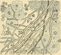 An illustration from Clinical diagnosis : the bacteriological, chemical, and microscopical evidence of disease / by Rudolf v. Jaksch ; tr. from the 3rd German ed. and enlarged by James Cagney ; with numerous illustrations (partly in colours). (1893)