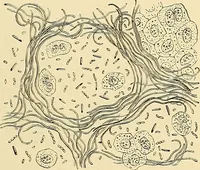 An illustration from Clinical diagnosis : the bacteriological, chemical, and microscopical evidence of disease / by Rudolf v. Jaksch ; tr. from the 3rd German ed. and enlarged by James Cagney ; with numerous illustrations (partly in colours). (1893)