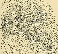 An illustration from Clinical diagnosis : the bacteriological, chemical, and microscopical evidence of disease / by Rudolf v. Jaksch ; tr. from the 3rd German ed. and enlarged by James Cagney ; with numerous illustrations (partly in colours). (1893)