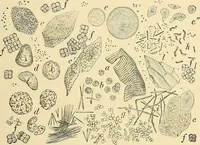 An illustration from Clinical diagnosis : the bacteriological, chemical, and microscopical evidence of disease / by Rudolf v. Jaksch ; tr. from the 3rd German ed. and enlarged by James Cagney ; with numerous illustrations (partly in colours). (1893)