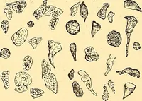 An illustration from Clinical diagnosis : the bacteriological, chemical, and microscopical evidence of disease / by Rudolf v. Jaksch ; tr. from the 3rd German ed. and enlarged by James Cagney ; with numerous illustrations (partly in colours). (1893)