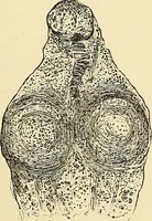 An illustration from Clinical diagnosis : the bacteriological, chemical, and microscopical evidence of disease / by Rudolf v. Jaksch ; tr. from the 3rd German ed. and enlarged by James Cagney ; with numerous illustrations (partly in colours). (1893)