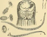An illustration from Clinical diagnosis : the bacteriological, chemical, and microscopical evidence of disease / by Rudolf v. Jaksch ; tr. from the 3rd German ed. and enlarged by James Cagney ; with numerous illustrations (partly in colours). (1893)