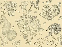 An illustration from Clinical diagnosis : the bacteriological, chemical, and microscopical evidence of disease / by Rudolf v. Jaksch ; tr. from the 3rd German ed. and enlarged by James Cagney ; with numerous illustrations (partly in colours). (1893)