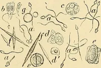 An illustration from Clinical diagnosis : the bacteriological, chemical, and microscopical evidence of disease / by Rudolf v. Jaksch ; tr. from the 3rd German ed. and enlarged by James Cagney ; with numerous illustrations (partly in colours). (1893)
