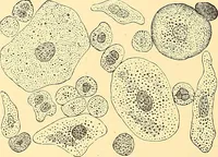 An illustration from Clinical diagnosis : the bacteriological, chemical, and microscopical evidence of disease / by Rudolf v. Jaksch ; tr. from the 3rd German ed. and enlarged by James Cagney ; with numerous illustrations (partly in colours). (1893)