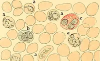 An illustration from Clinical diagnosis : the bacteriological, chemical, and microscopical evidence of disease / by Rudolf v. Jaksch ; tr. from the 3rd German ed. and enlarged by James Cagney ; with numerous illustrations (partly in colours). (1893)