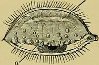 An illustration from Diseases of the eye / by Edward Nettleship ; with a supplement on examinations for color-blindness and acuity of vision and hearing, by William Thomson ; with 5 colored plates and 192 engravings. (1900)