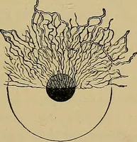 An illustration from Diseases of the eye / by Edward Nettleship ; with a supplement on examinations for color-blindness and acuity of vision and hearing, by William Thomson ; with 5 colored plates and 192 engravings. (1900)