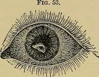 An illustration from Diseases of the eye / by Edward Nettleship ; with a supplement on examinations for color-blindness and acuity of vision and hearing, by William Thomson ; with 5 colored plates and 192 engravings. (1900)