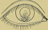 An illustration from Diseases of the eye / by Edward Nettleship ; with a supplement on examinations for color-blindness and acuity of vision and hearing, by William Thomson ; with 5 colored plates and 192 engravings. (1900)