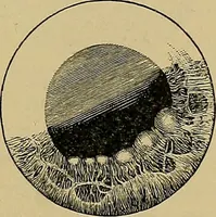 An illustration from Diseases of the eye / by Edward Nettleship ; with a supplement on examinations for color-blindness and acuity of vision and hearing, by William Thomson ; with 5 colored plates and 192 engravings. (1900)