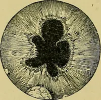 An illustration from Diseases of the eye / by Edward Nettleship ; with a supplement on examinations for color-blindness and acuity of vision and hearing, by William Thomson ; with 5 colored plates and 192 engravings. (1900)