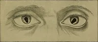 An illustration from Diseases of the eye / by Edward Nettleship ; with a supplement on examinations for color-blindness and acuity of vision and hearing, by William Thomson ; with 5 colored plates and 192 engravings. (1900)
