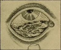 An illustration from Diseases of the eye / by Edward Nettleship ; with a supplement on examinations for color-blindness and acuity of vision and hearing, by William Thomson ; with 5 colored plates and 192 engravings. (1900)